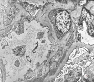 M,21y. | IgA nephropathy (Berger disease) M,21y. | IgA nephropathy (Berger disease)